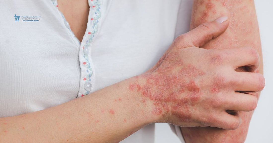 Compounded Amlexanox: A Multi-Target Anti-Inflammatory Therapy for Complex Chronic Conditions