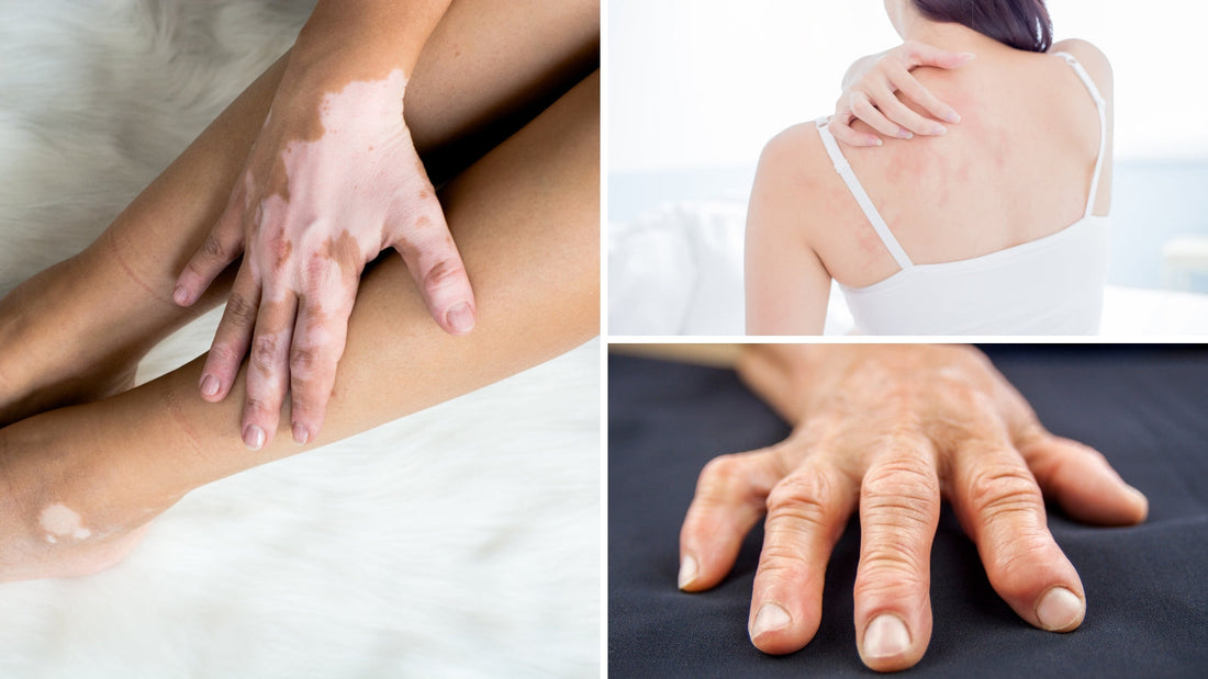 Compounding & Autoimmune Diseases: Uses of Low-Dose Naltrexone in Autoimmune Conditions