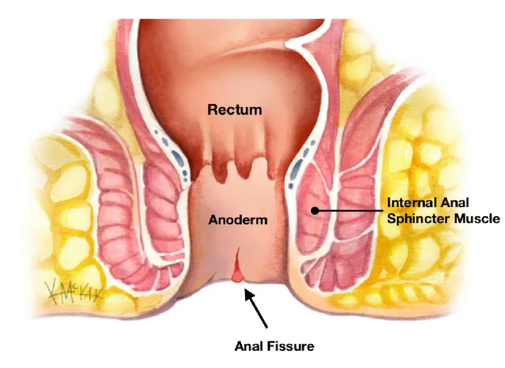 Anal Fissure Diagram